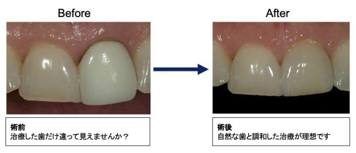 白い差し歯 審美歯科 都島区大東町の歯医者 ゆう歯科クリニック むし歯 入れ歯 歯石の治療